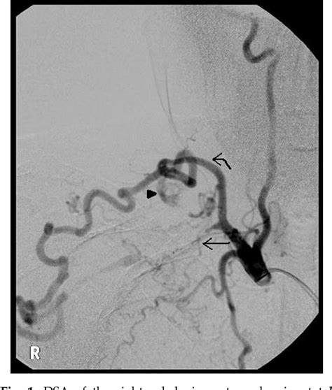 Figure 1 From Collateral Artery Aneurysm A Unique Presentation Of