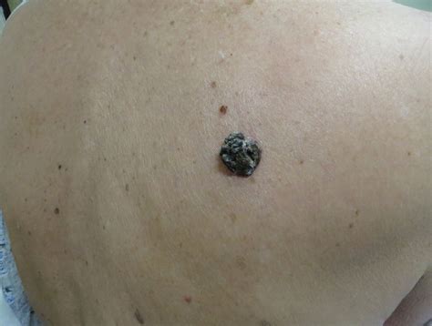 Dark Brown Hyperkeratotic Nodule On The Back Mdedge Dermatology