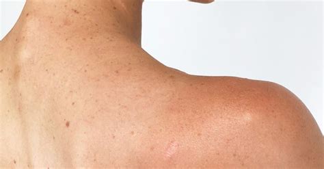 Scar tissue that suddenly develops a new sore. This Is What a Melanoma Scar Looks Like