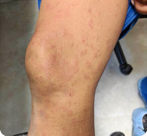 Urticarial Erythematous Papules In A Pregnant Woman Aafp