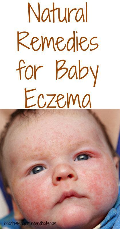 Natural Remedies For Eczema Baby Eczema Natural Eczema Remedies