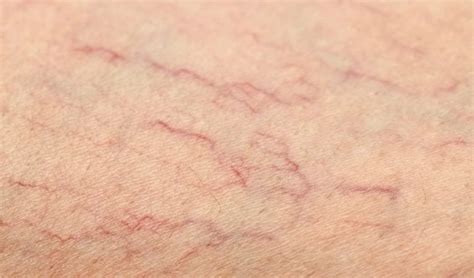 This can happen if you simply spend a long. 10 Causes of Broken Capillaries (Spider Veins) | Thrombocytes