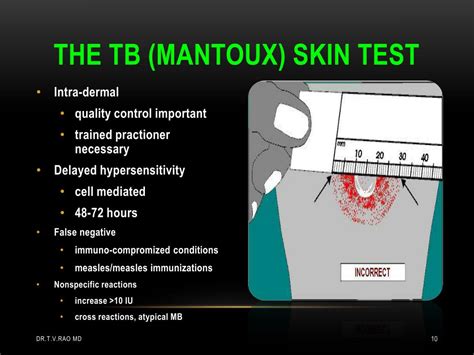 Ppt Tuberculin Skin Testing Mantoux Tuberculin Skin Test Powerpoint