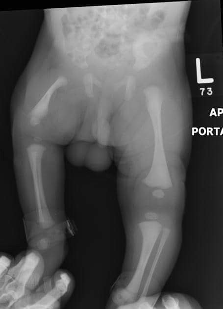 Finally Proximal Femoral Focal Deficiency Is A Congenital Partial Absence Of The Proximal End