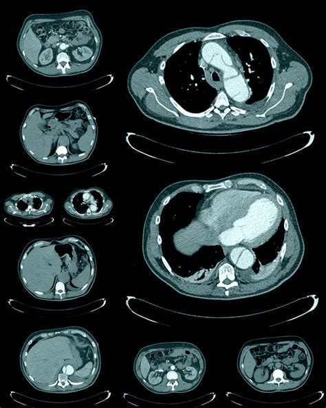 What Are Chest Or Thorax Ct Scans Two Views