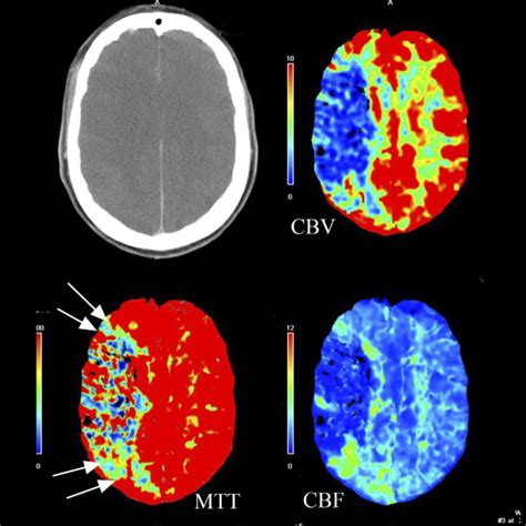 Neuroimaging In Acute Stroke Choosing The Right Patient For