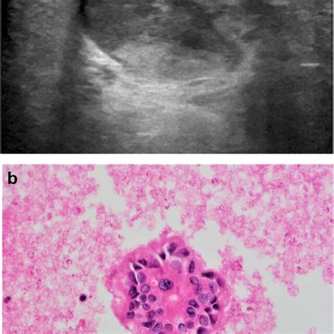 A Normal Mammogram In A 28 Year Old Lactating Patient 9 Months