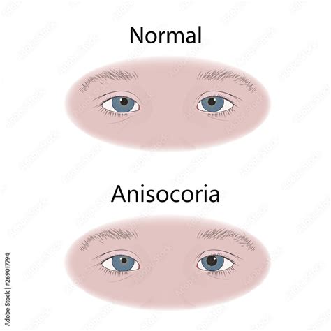 Anisocoria In Infants Child Kid Pupils Of Different Sizes Vector
