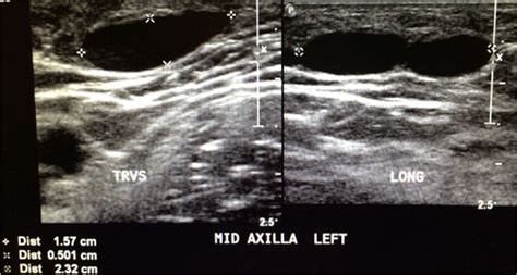 Variation In Galactocele Location And Sonographic Appearance Madlyn R