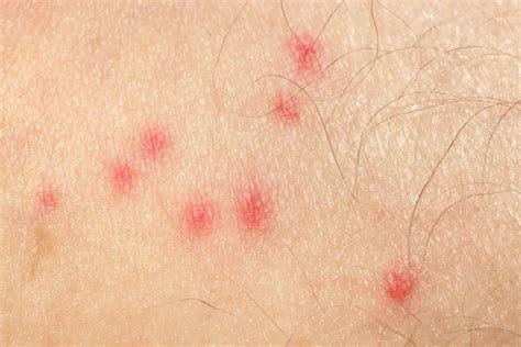 Mosquito Bites Allergic Reaction