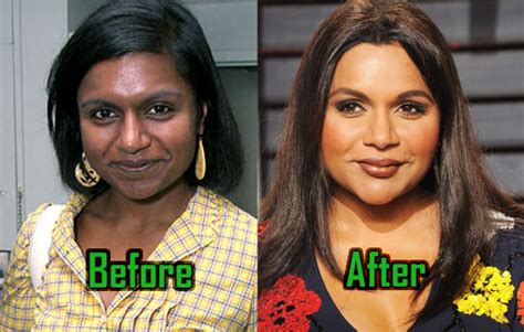 Mindy Kaling Plastic Surgery Enhances Her Nose And Lips Before After