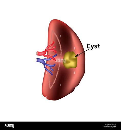 Anatomical Structure Of The Spleen Spleen Cyst Vector Illustration On