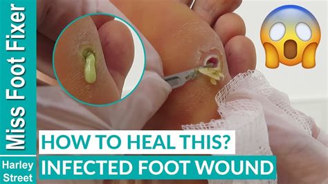 How To Treat Infected Foot Wound With Pus By Miss Foot Fixer Marion Yau