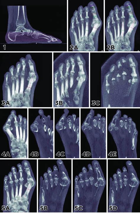Sequence Of Hallux Valgus Angles Measurements Using Weight Bearing