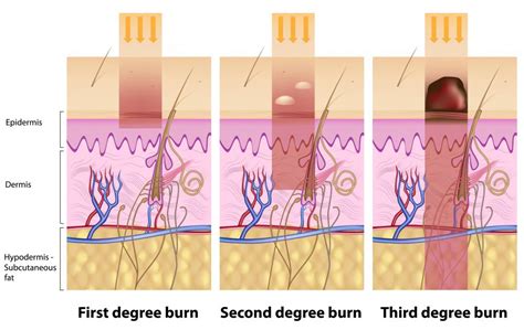 What Is The Treatment For Third Degree Burns With Pictures