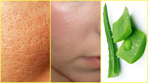 There are no quick fixes for getting. How To Get Rid Of Large Pores │Smooth, Tight, Young Skin ...