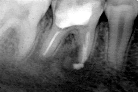 Clinical Case Non Surgical Management Of A Periapical Abscess In A
