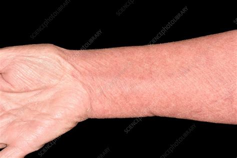 Erythrodermic Psoriasis Stock Image C0426398 Science Photo Library