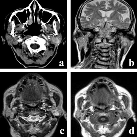 A Axial Contrast Enhanced Ct Scan Shows A Well Defined Oval Smooth
