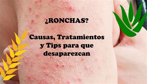 ¿ronchas 😫 Deja De Rascarte Descubre Causas Tratamientos Y Tips Para