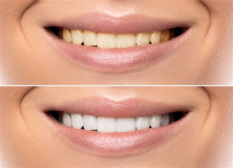 smile makeovers treatments and how they work rinaldi dental arts