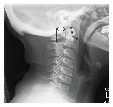 Lateral Radiographs Of A Patient With Atlantoaxial Instability In The