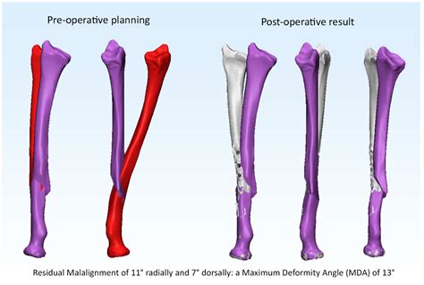Children Free Full Text Accuracy Of 3d Corrective Osteotomy For