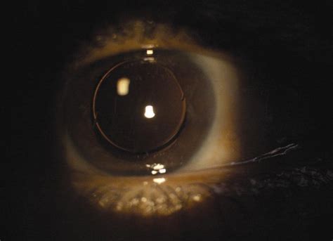 Vertical Fixation With Fibrin Glue Assisted Secondary Posterior Chamber Intraocular Lens