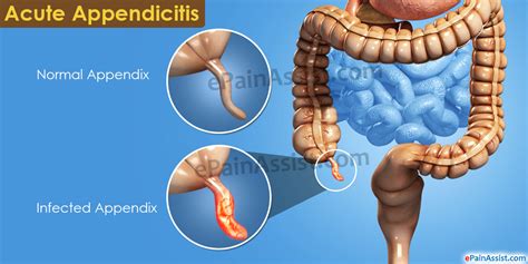 Acute Pain Pain In Acute Appendicitis