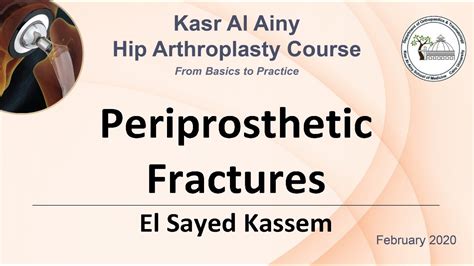 5 1 Periprosthetic Fractures El Sayed Kassem Youtube