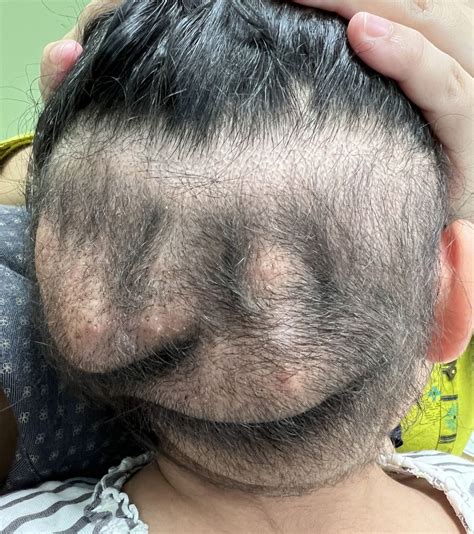 New Scalp Swelling In A Child With Tuberous Sclerosis Complex