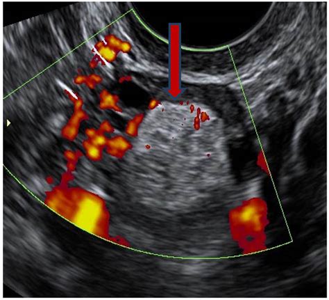 place of doppler ultrasound in the characterization of ovarian cysts about 35 cases