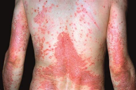 Developing New Psoriasis Treatment Regimens For Patients Based On Their