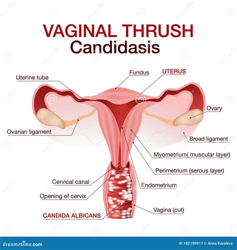 Vulvovaginal Candidiasis Or Vaginal Yeast Infection Vector Illustration Stock Vector