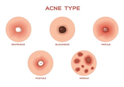 Each type requires a different treatment. Different Types Of Acne, Learn What Acne Type You Have ...