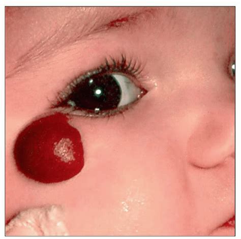 infantile juvenile hemangioma basicmedical key