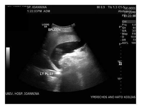 Ascites Fluid Accumulation In The Peritoneal Cavity Download