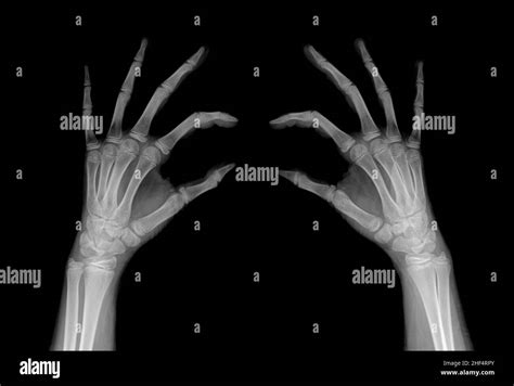 Radiografía De Los Dedos De Las Manos En Comparación Fotografía De