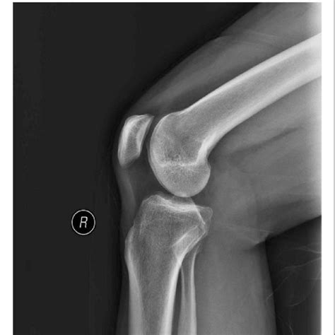 Radiograph Of Lateral Knee Joint Captured In Optimizedposition