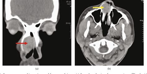 Pdf Pleomorphic Adenoma Presenting As An Atypical Nasal Mass In A 26