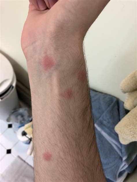 How Long Do You Itch After Bed Bug Bites Bed Western