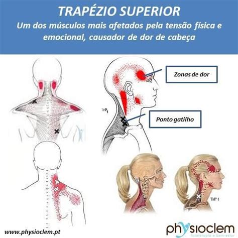 cefaleia de tensão provocada pelo músculo trapézio superior physioclem