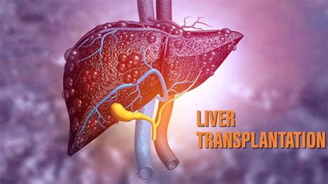 The Basics Of Liver Transplant What You Need To Know