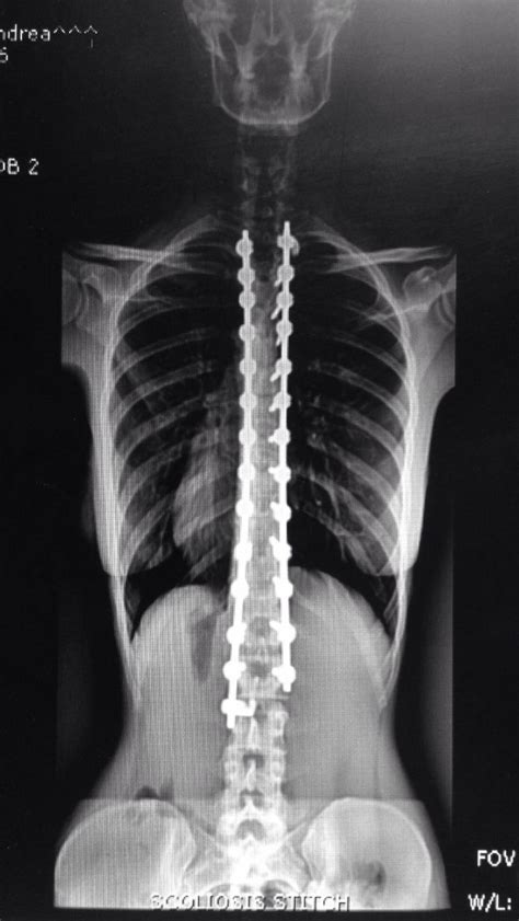 2 1 2 Month Post Op X Ray Of My Spinal Fusion Spinal Fusion Necklace Spinal