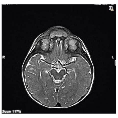The Patients Brain Mri In The T2 Weighted Sequence The Intracranial