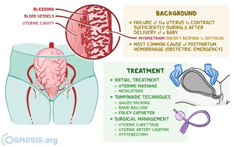 Postpartum Haemorrhage