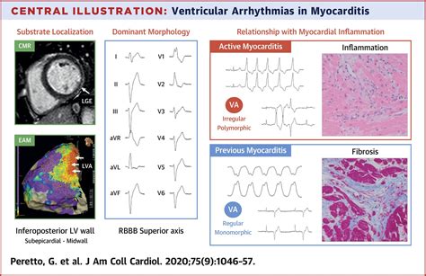 Ventricular Arrhythmias In Myocarditis Characterization And