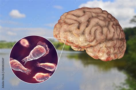 Brain Eating Amoeba Infection Naegleriasis Trophozoite Form Of The Parasite Naegleria Fowleri