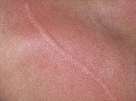 Severe Pruritus In An 11 Month Old Infant—quiz Case Dermatology