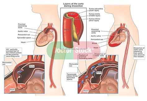 Aortic Dissection Doctor Stock